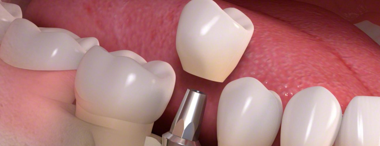 B_Implant-borne_single-tooth_treatment_03