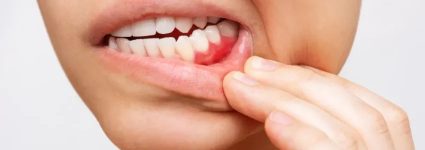 gum-inflammation-cropped-shot-young-woman-showing-red-bleeding-gums